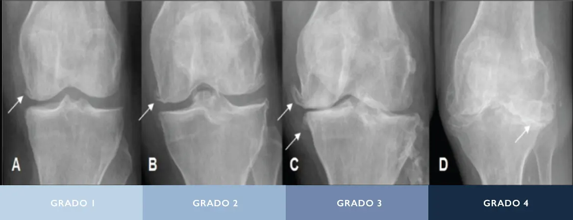 Radiografías de rodilla con distintos grados de osteoartritis